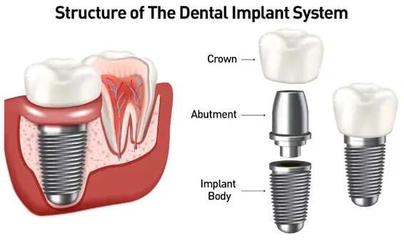 Dentist near me, dentista cerca de mi, best dentist miami, mejor dentista miami, pizza near me, chinese near me, food near me, crown dentist miami, cheapest dentist miami, root canal dentist miami, cheapest root canal miami