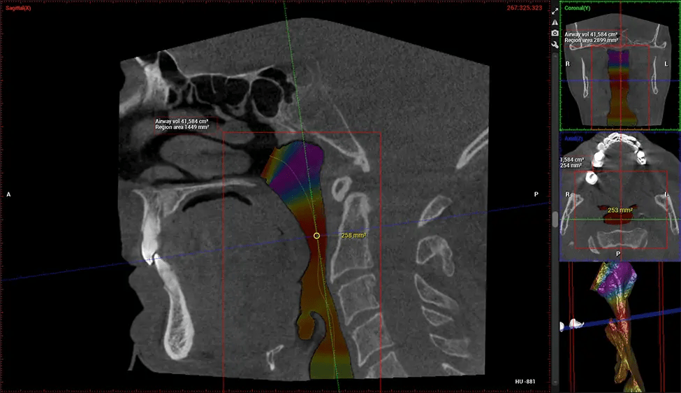 Planmeca CBCT Low Radiation G7 Airway Study Miami