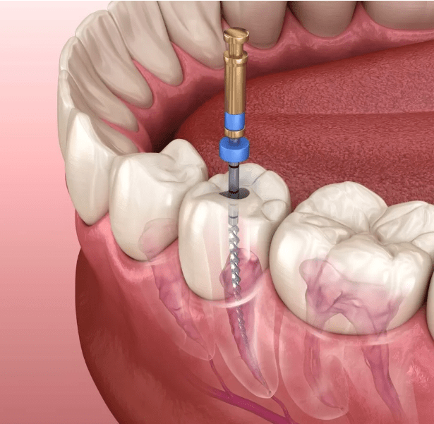 Esta es una imagen en miniatura del blog Terapia de conducto radicular: tecnología avanzada con precios asequibles